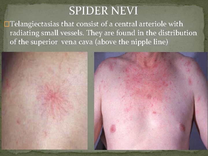 SPIDER NEVI �Telangiectasias that consist of a central arteriole with radiating small vessels. They