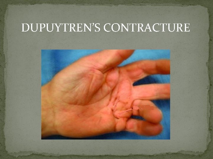 DUPUYTREN’S CONTRACTURE 