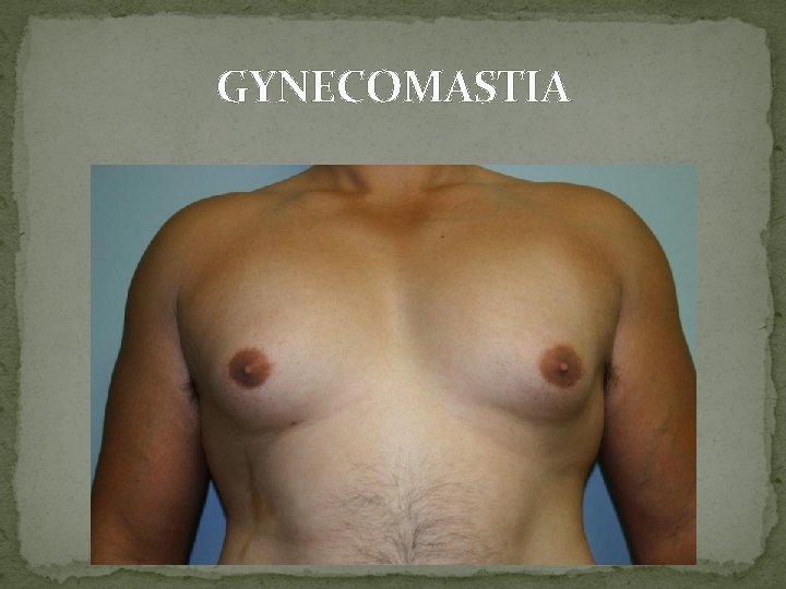 GYNECOMASTIA 