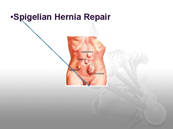  • Spigelian Hernia Repair 