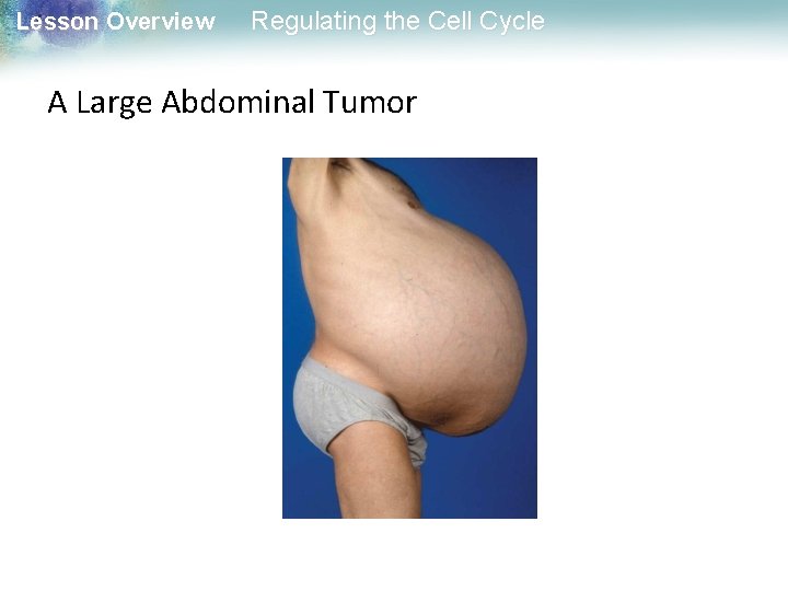 Lesson Overview Regulating the Cell Cycle A Large Abdominal Tumor 