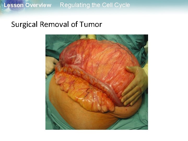 Lesson Overview Regulating the Cell Cycle Surgical Removal of Tumor 