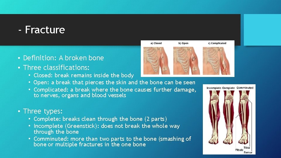 - Fracture • Definition: A broken bone • Three classifications: • Closed: break remains