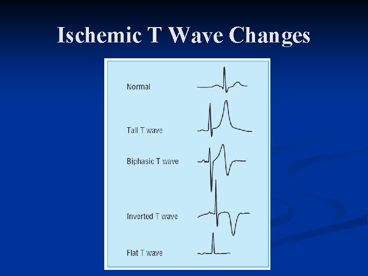 Ischemic T Wave Changes 
