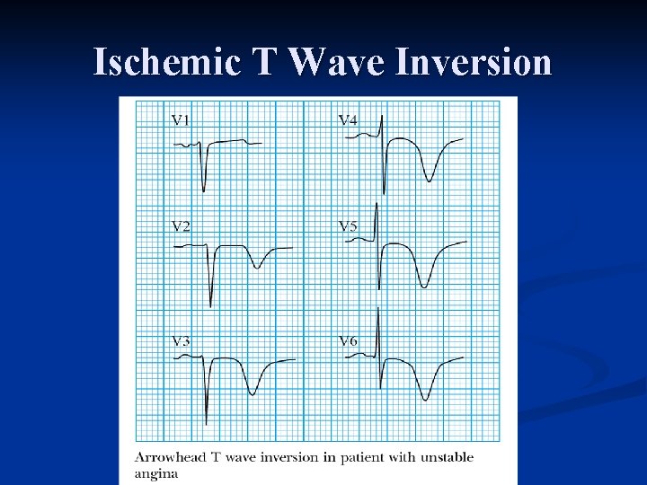 Ischemic T Wave Inversion 