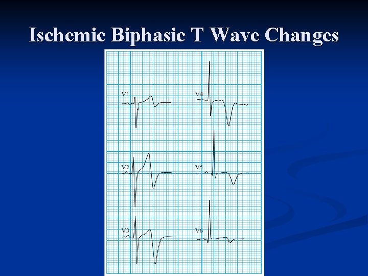 Ischemic Biphasic T Wave Changes 
