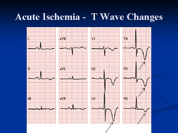 Acute Ischemia - T Wave Changes 