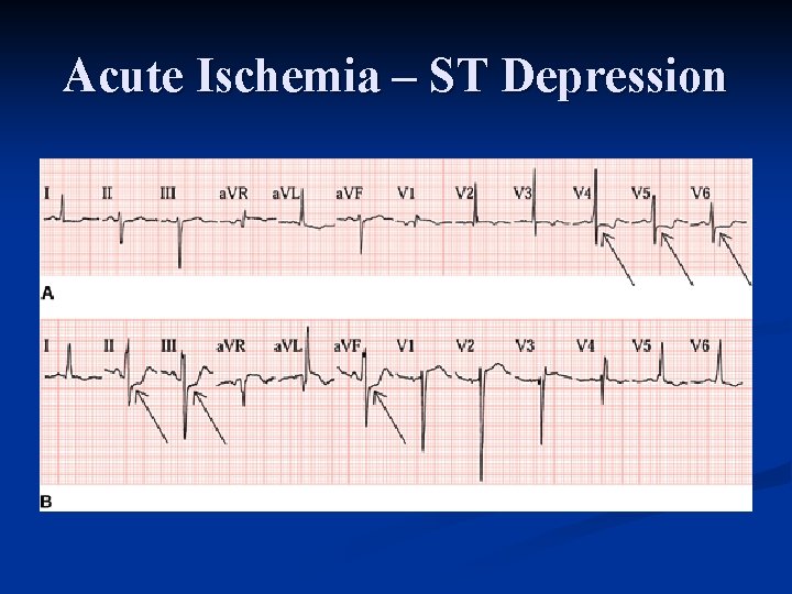 Acute Ischemia – ST Depression 