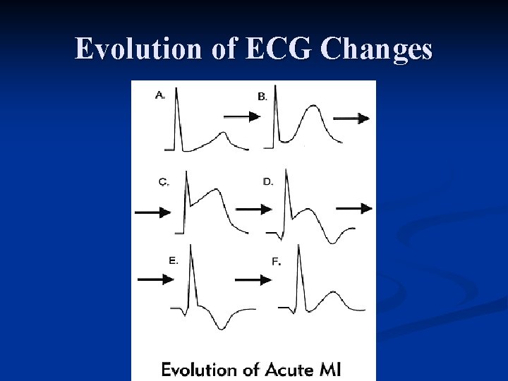Evolution of ECG Changes 