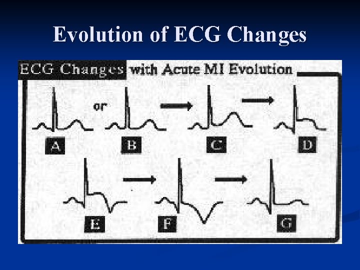 Evolution of ECG Changes 