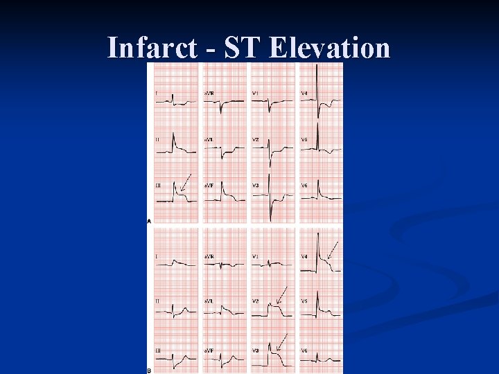 Infarct - ST Elevation 