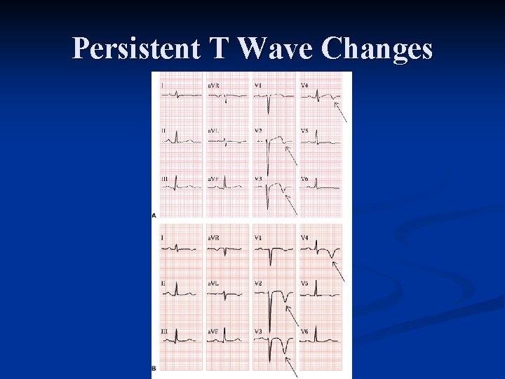 Persistent T Wave Changes 
