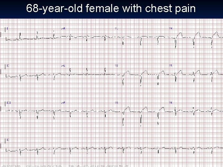 68 -year-old female with chest pain 