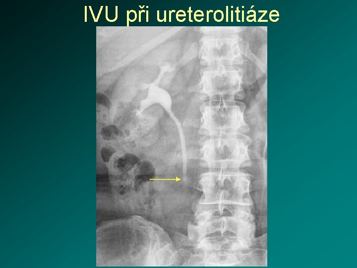 IVU při ureterolitiáze 