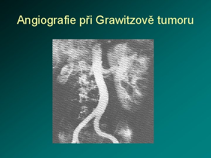 Angiografie při Grawitzově tumoru 