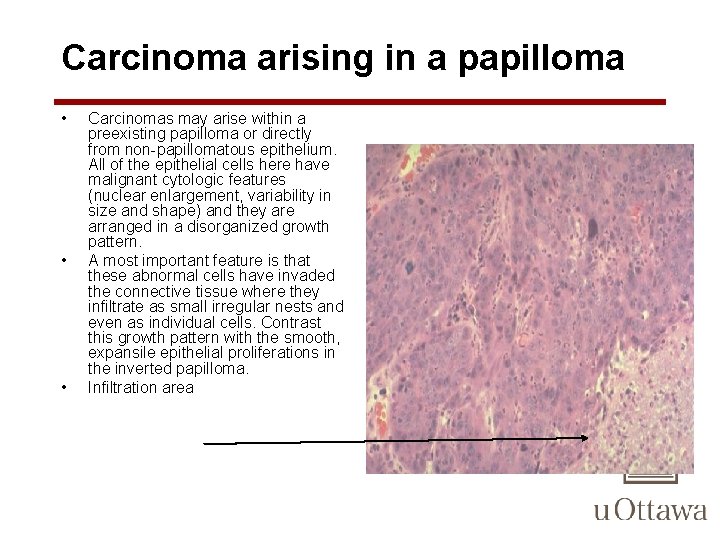 Carcinoma arising in a papilloma • • • Carcinomas may arise within a preexisting