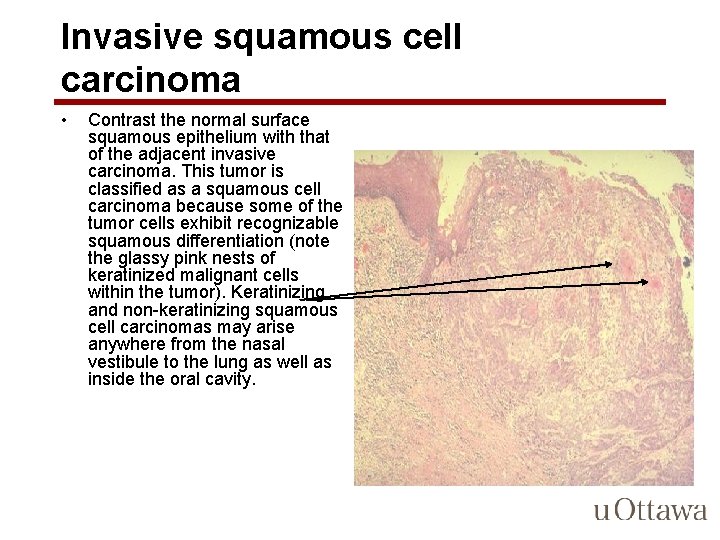 Invasive squamous cell carcinoma • Contrast the normal surface squamous epithelium with that of