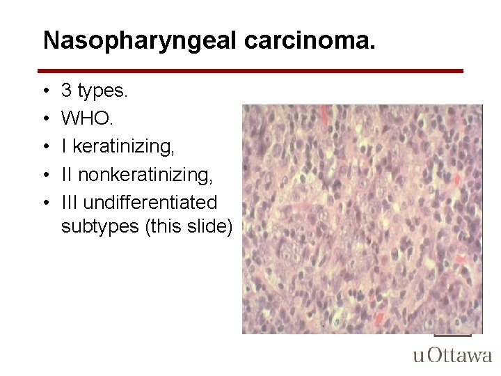 Nasopharyngeal carcinoma. • • • 3 types. WHO. I keratinizing, II nonkeratinizing, III undifferentiated