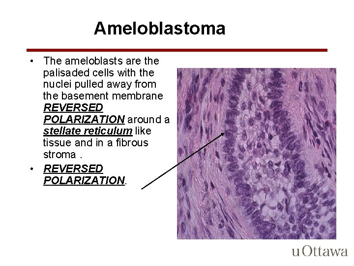 Ameloblastoma • The ameloblasts are the palisaded cells with the nuclei pulled away from