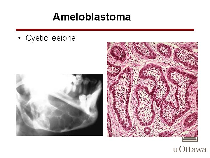 Ameloblastoma • Cystic lesions 