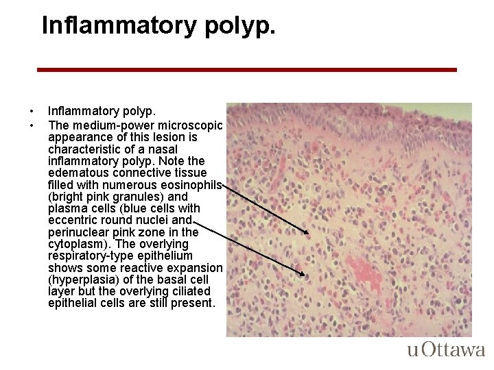 Inflammatory polyp. • • Inflammatory polyp. The medium-power microscopic appearance of this lesion is