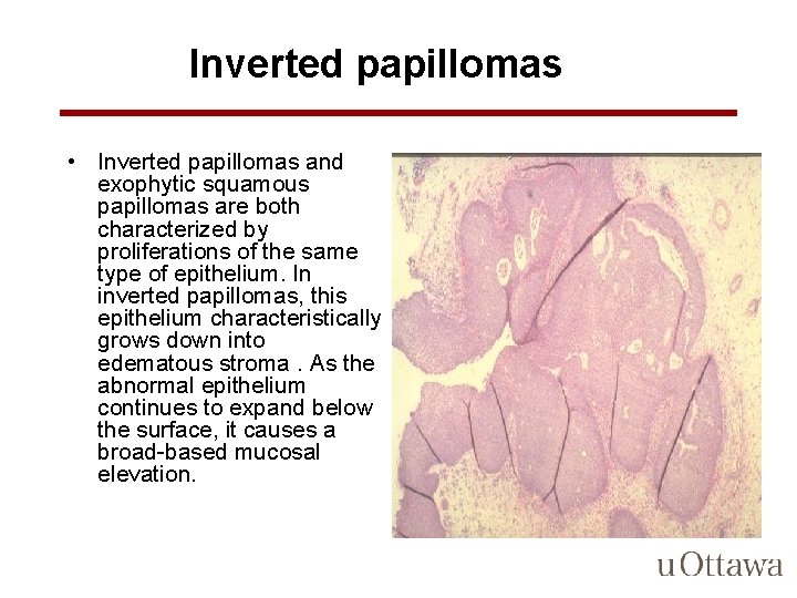Inverted papillomas • Inverted papillomas and exophytic squamous papillomas are both characterized by proliferations