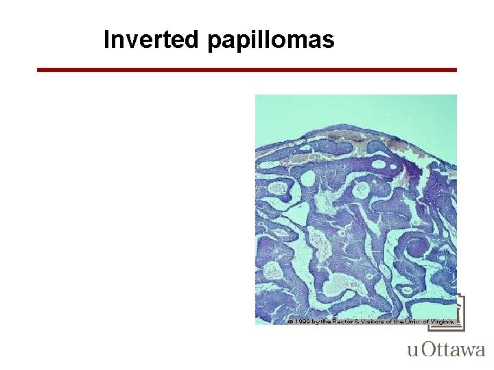 Inverted papillomas 