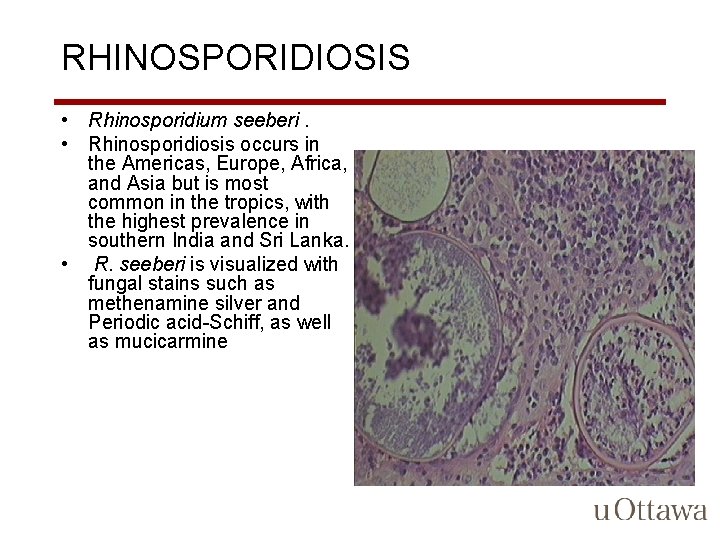 RHINOSPORIDIOSIS • Rhinosporidium seeberi. • Rhinosporidiosis occurs in the Americas, Europe, Africa, and Asia