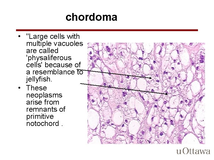 chordoma • "Large cells with multiple vacuoles are called 'physaliferous cells' because of a