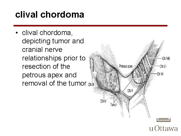 clival chordoma • clival chordoma, depicting tumor and cranial nerve relationships prior to resection