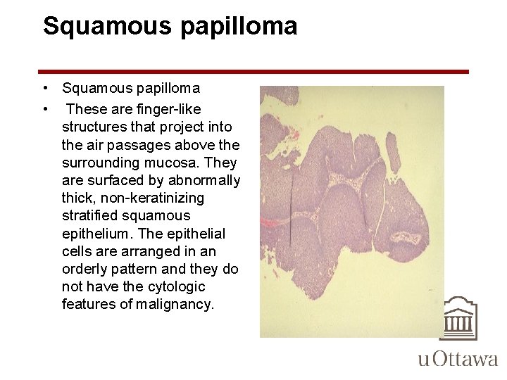 Squamous papilloma • These are finger-like structures that project into the air passages above