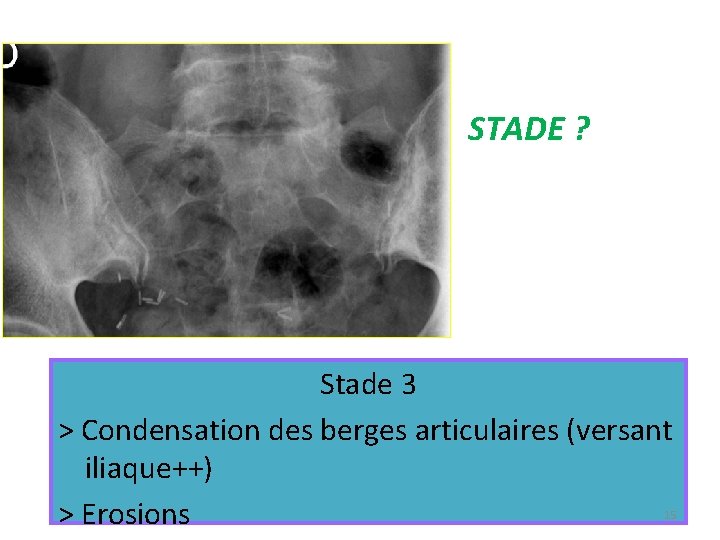 STADE ? Stade 3 > Condensation des berges articulaires (versant iliaque++) > Erosions 15