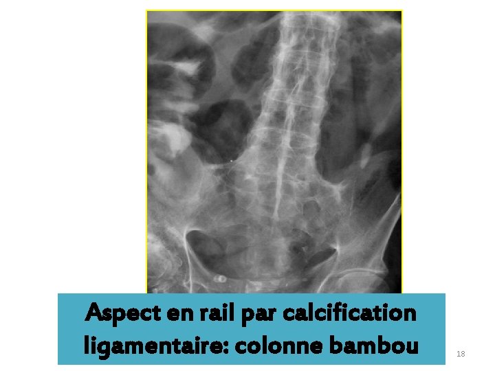 Aspect en rail par calcification ligamentaire: colonne bambou 18 