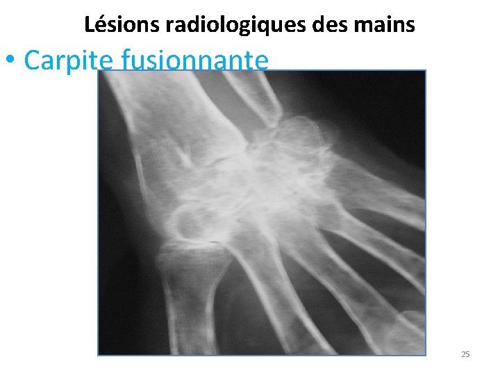 Lésions radiologiques des mains • Carpite fusionnante 25 