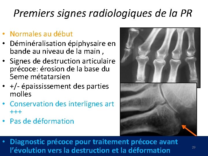 Premiers signes radiologiques de la PR • Normales au début • Déminéralisation épiphysaire en