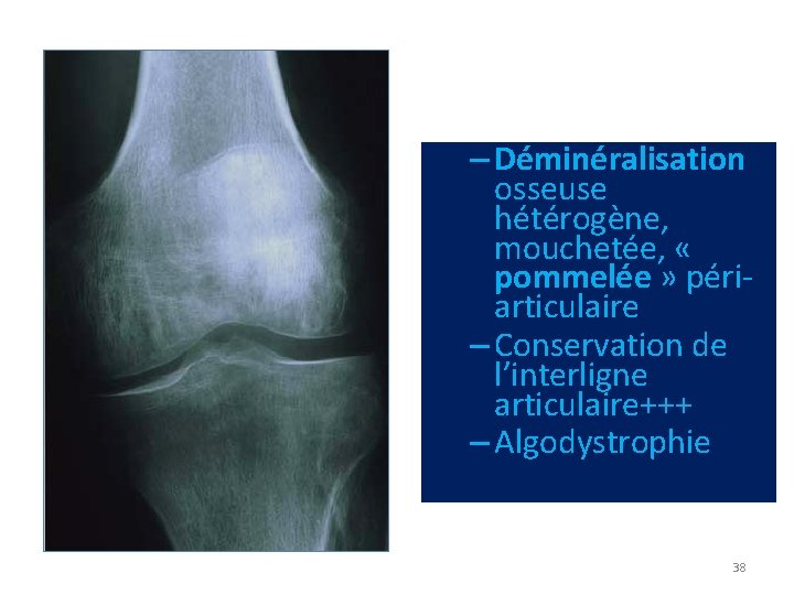 – Déminéralisation osseuse hétérogène, mouchetée, « pommelée » périarticulaire – Conservation de l’interligne articulaire+++