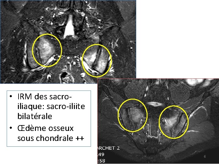  • IRM des sacroiliaque: sacro-iliite bilatérale • Œdème osseux sous chondrale ++ 6