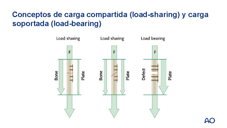 Fracturas mandibulares carga soportada y carga compartida Objetivos