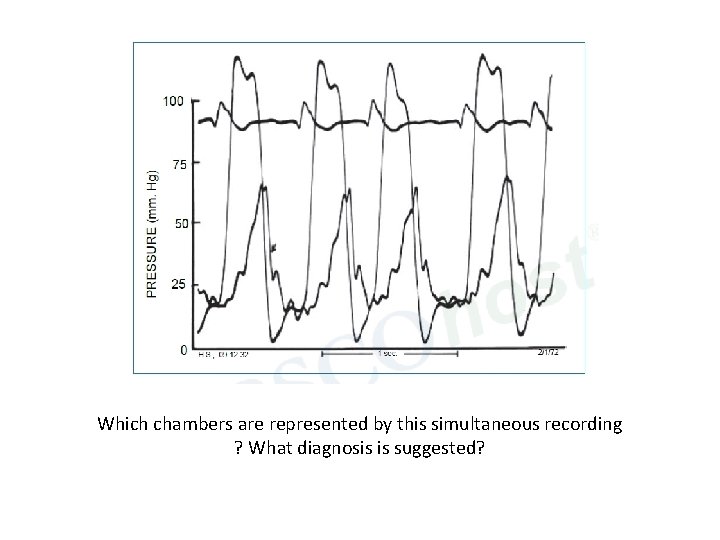 Which chambers are represented by this simultaneous recording ? What diagnosis is suggested? 