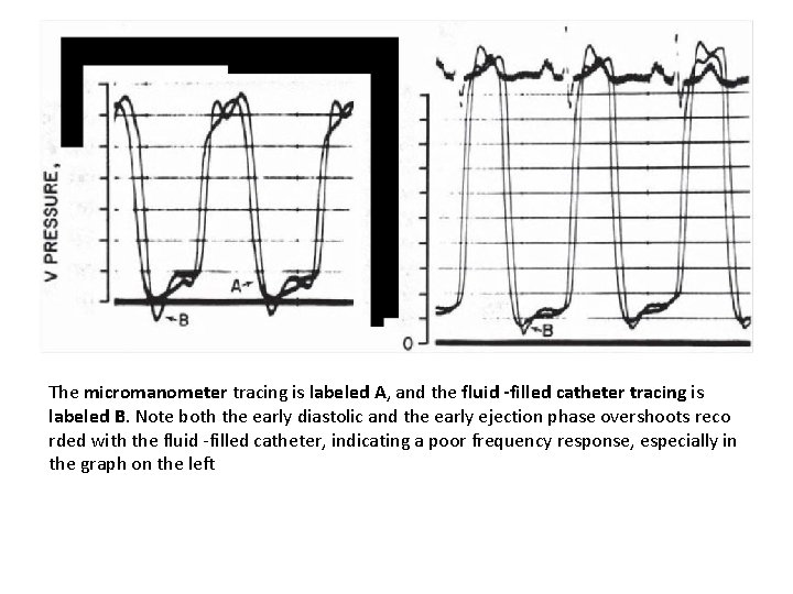 The micromanometer tracing is labeled A, and the fluid -filled catheter tracing is labeled