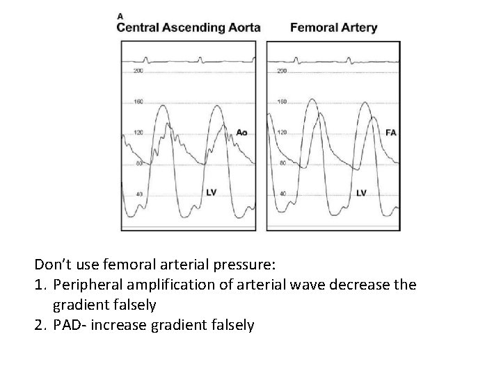 Don’t use femoral arterial pressure: 1. Peripheral amplification of arterial wave decrease the gradient