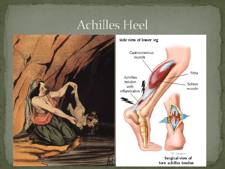 Achilles Heel 