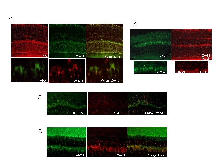 A B GS CDH 11 Merge 40 x oil Chx-10 Cralbp CDH 11 Merge A B GS CDH 11 Merge 40 x oil Chx-10 Cralbp CDH 11 Merge