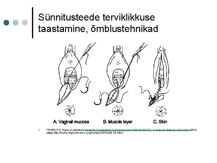 Sünnitusteede terviklikkuse taastamine, õmblustehnikad ¢ FIGURE P-41 Repair of episiotomy Managing Complications in Pregnancy Sünnitusteede terviklikkuse taastamine, õmblustehnikad ¢ FIGURE P-41 Repair of episiotomy Managing Complications in Pregnancy