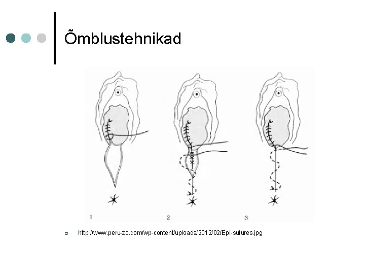 Õmblustehnikad ¢ http: //www. peru-zo. com/wp-content/uploads/2012/02/Epi-sutures. jpg Õmblustehnikad ¢ http: //www. peru-zo. com/wp-content/uploads/2012/02/Epi-sutures. jpg