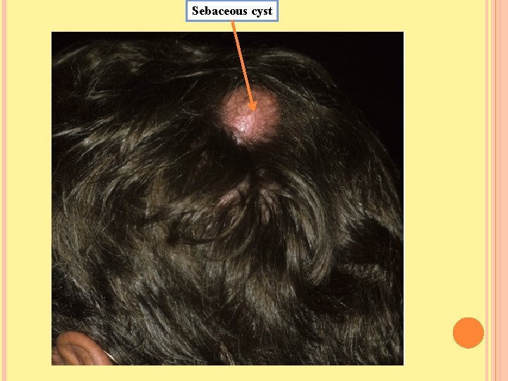 Sebaceous cyst 