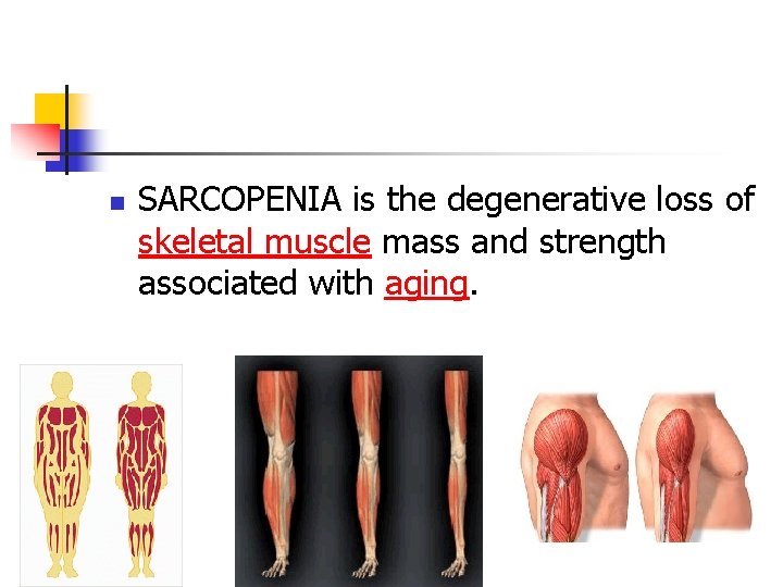 n SARCOPENIA is the degenerative loss of skeletal muscle mass and strength associated with
