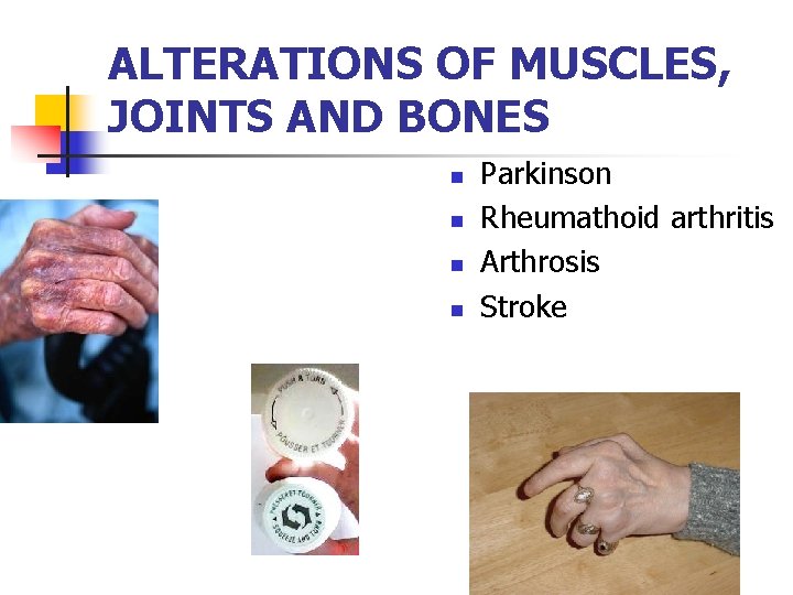 ALTERATIONS OF MUSCLES, JOINTS AND BONES n n Parkinson Rheumathoid arthritis Arthrosis Stroke 