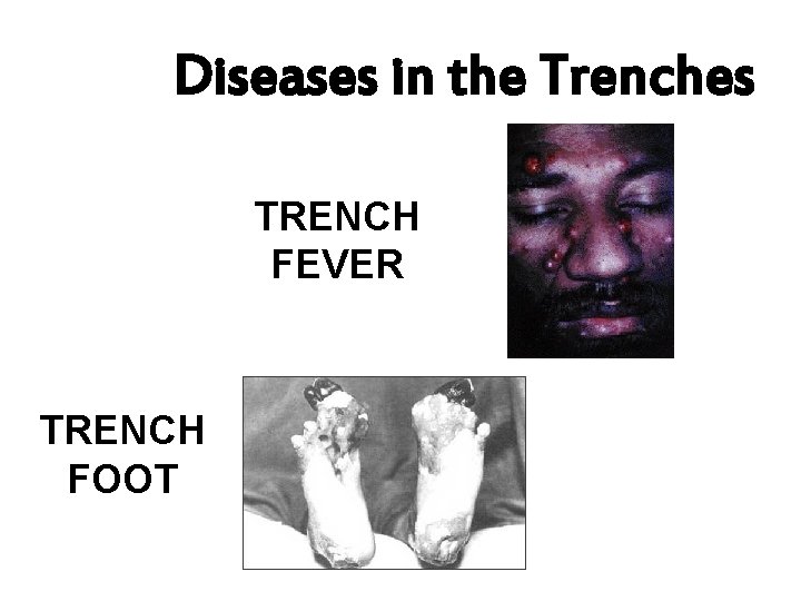 Diseases in the Trenches TRENCH FEVER TRENCH FOOT 