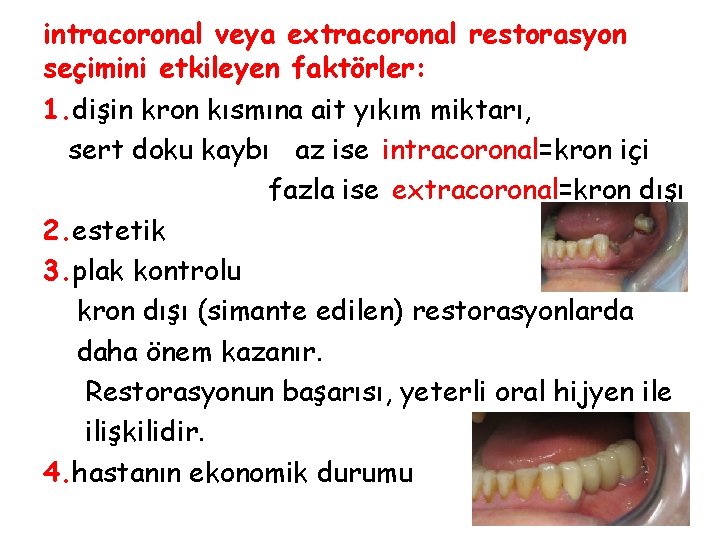 intracoronal veya extracoronal restorasyon seçimini etkileyen faktörler: 1. dişin kron kısmına ait yıkım miktarı,